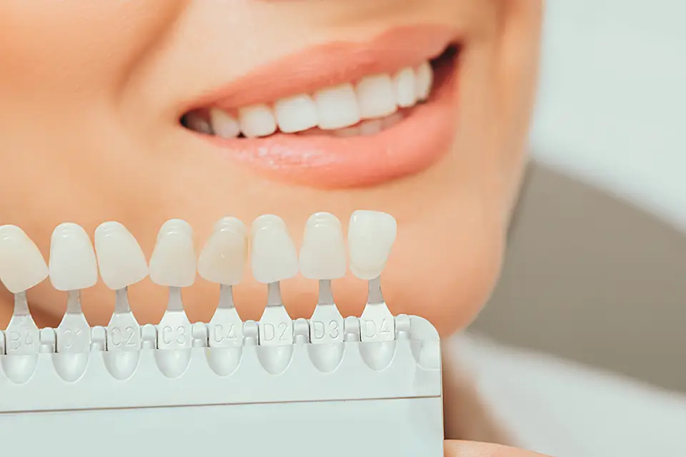 Difference Between Veneers and Composite Bonding: Which Option Fits Your Smile Best?