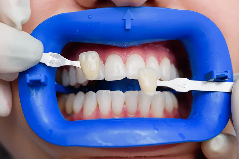 Teeth Whitening Durability: How Long Your Brightness Can Last