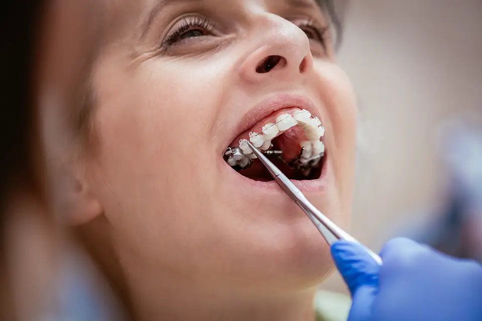 Orthodontics For Adults: Retention—The Part Everyone Forgets