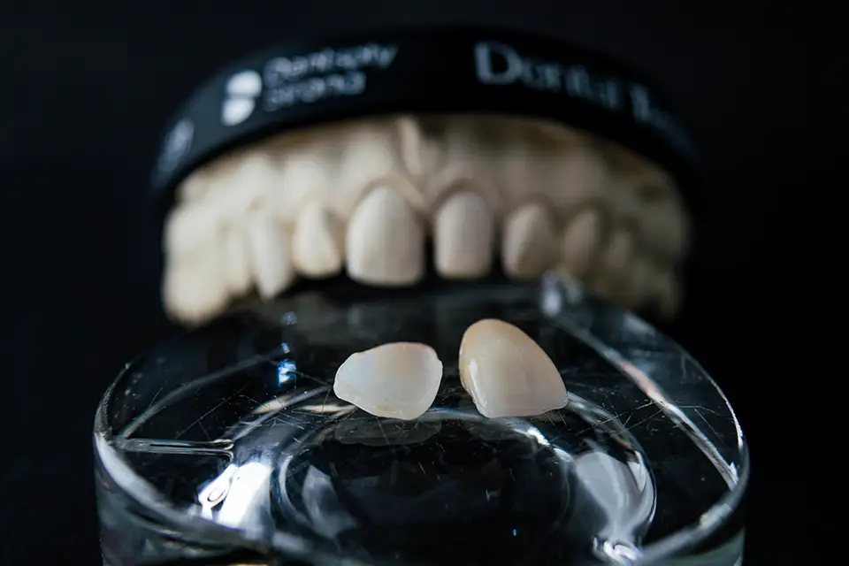 Dental Veneers vs Crowns: Fast Comparison to Narrow Your Choice