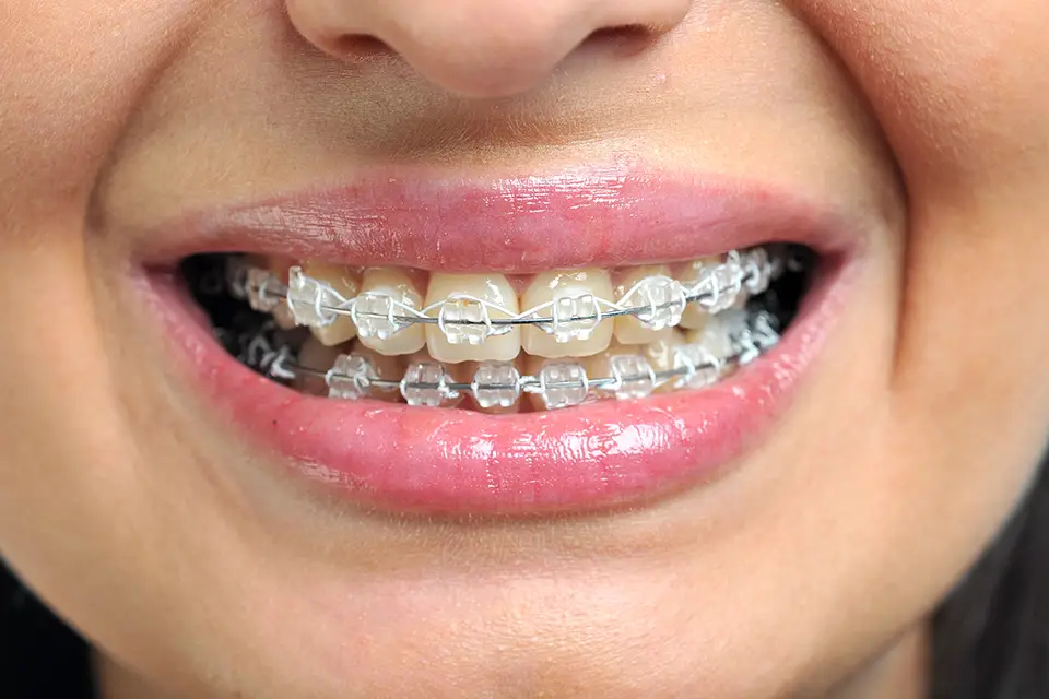 Average Time for Orthodontic Treatment: A Clear Timeline for Real-Life Results