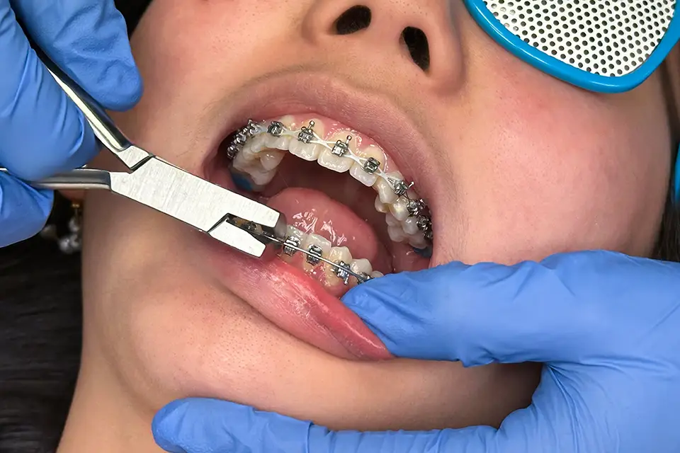 Costs And Timelines For Managing Risks And Complications Of Orthodontics