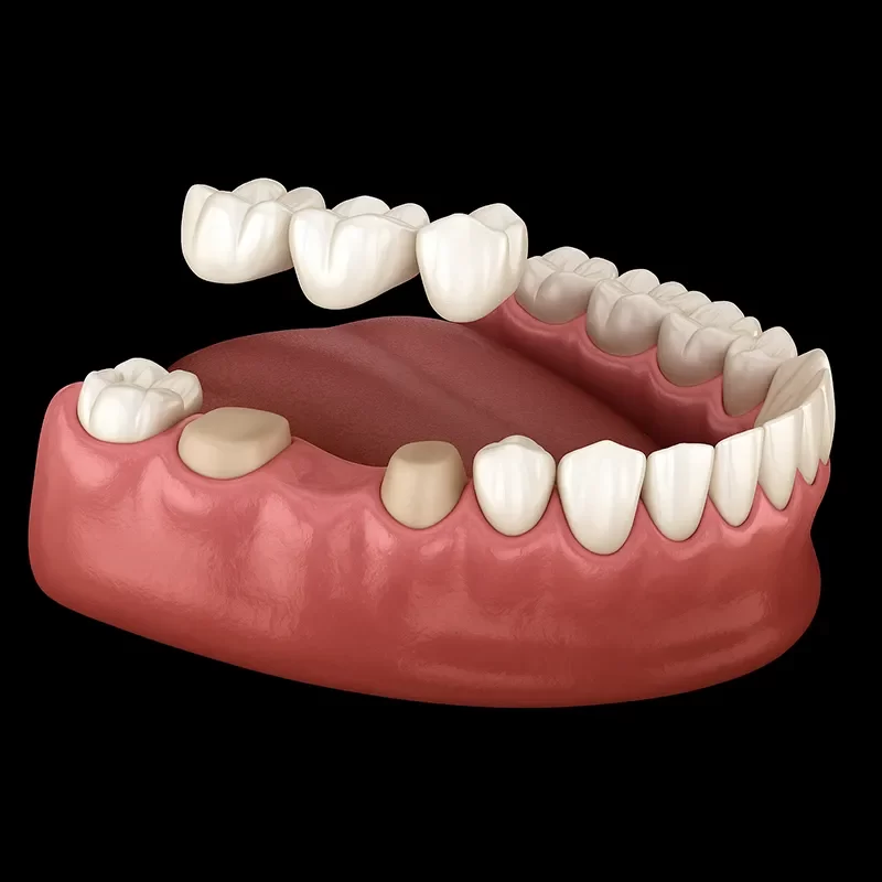 What Are Dental Bridges?