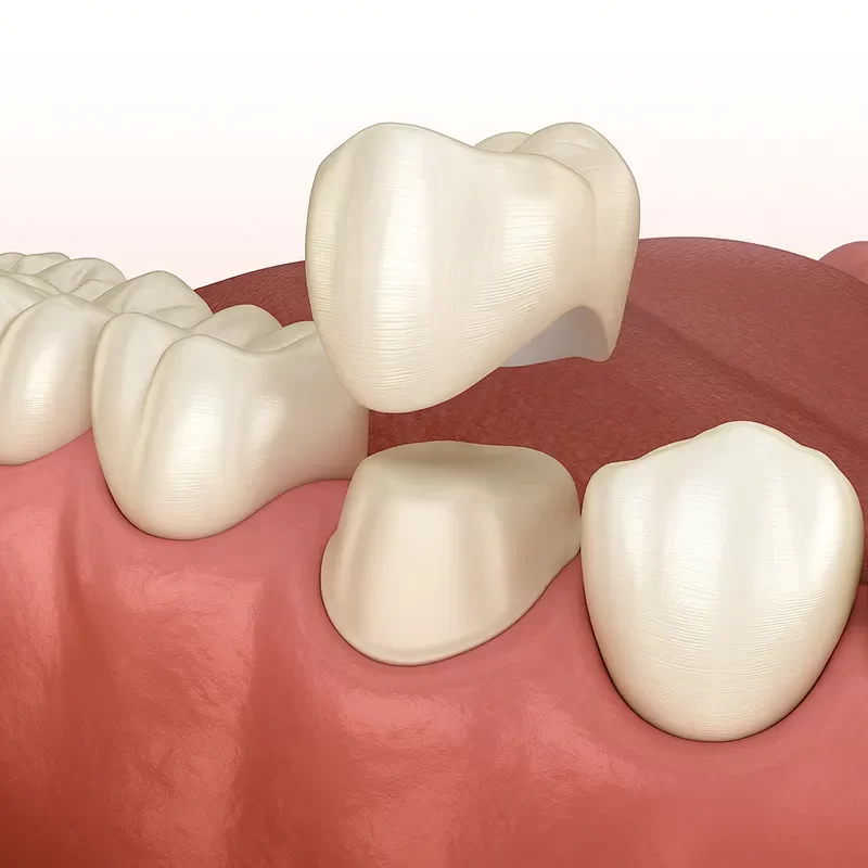 What Are Dental Crowns?