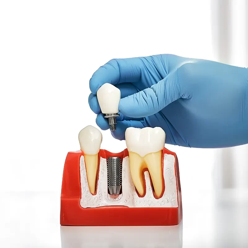 What Are Dental Implants?