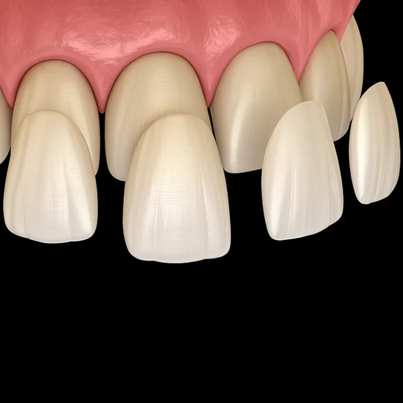 What Are Dental Veneers?