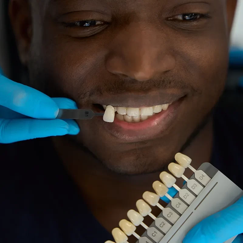 What to Expect During a Dental Veneers Visit