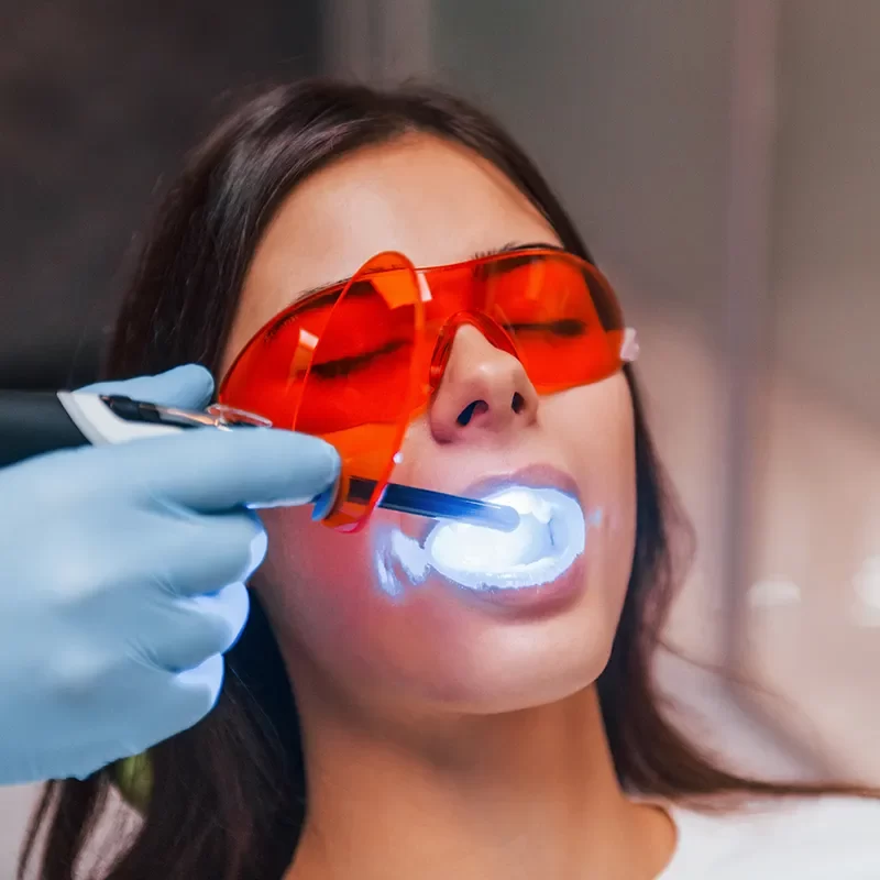 Fluoride Treatment Process​