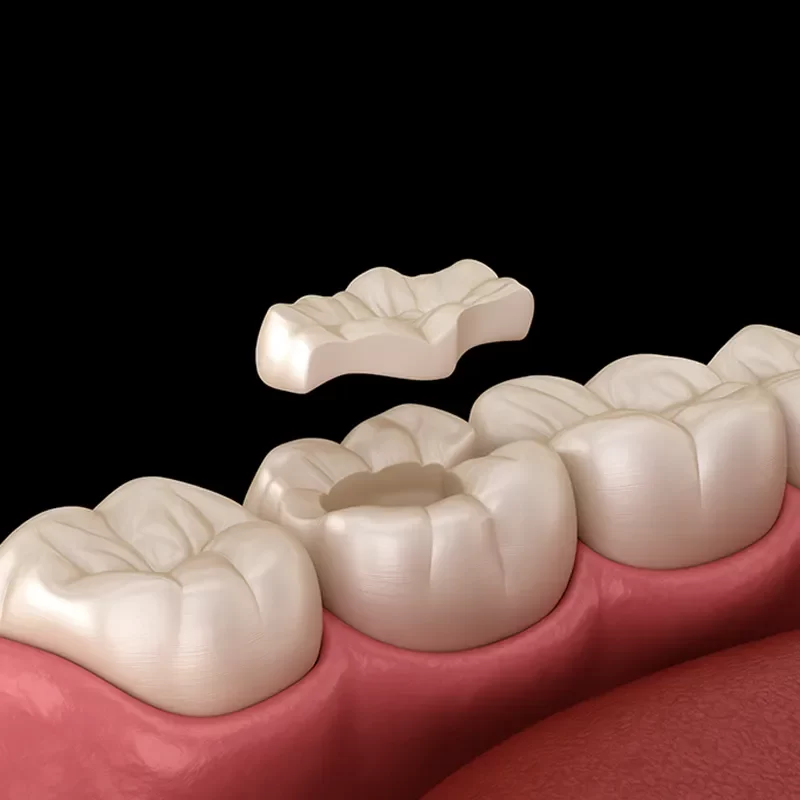 What Are Inlays and Onlays?