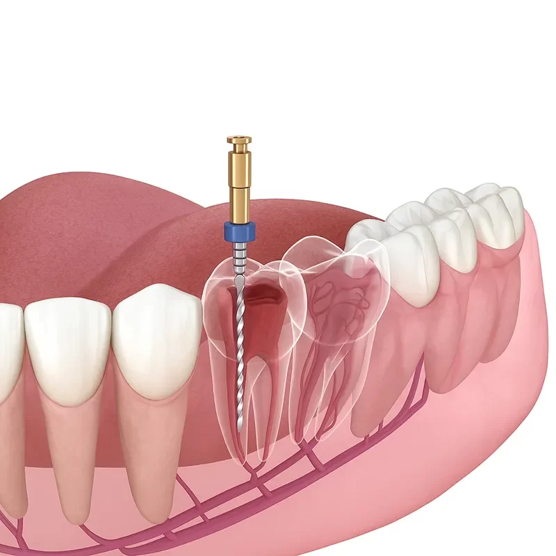 What Is Root Canal Therapy?