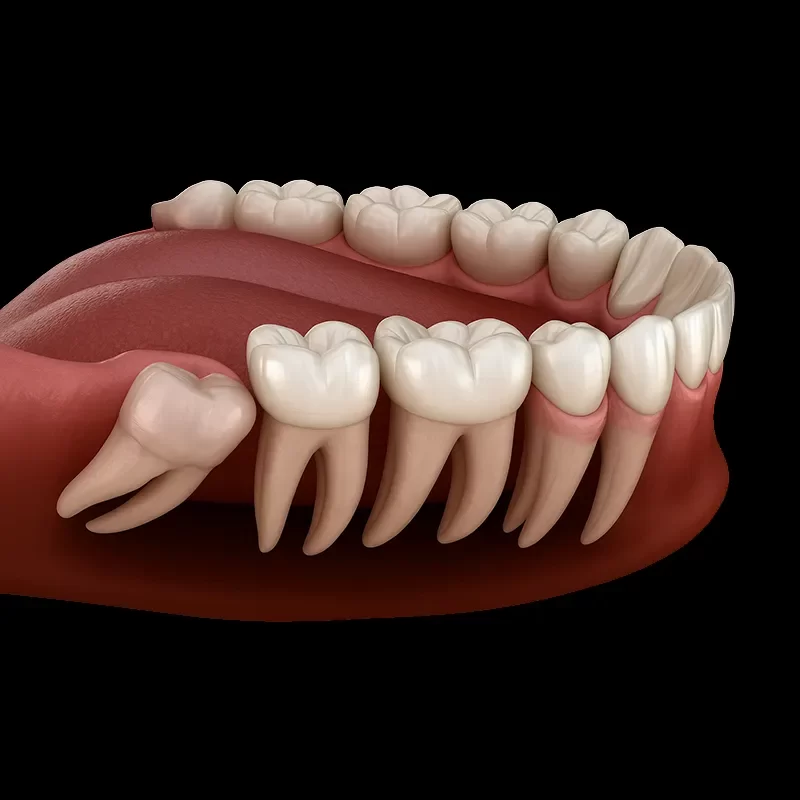 Wisdom Teeth Removal