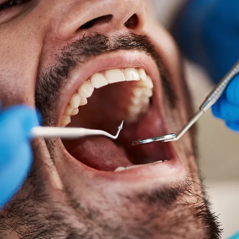 Wisdom Teeth Removal
