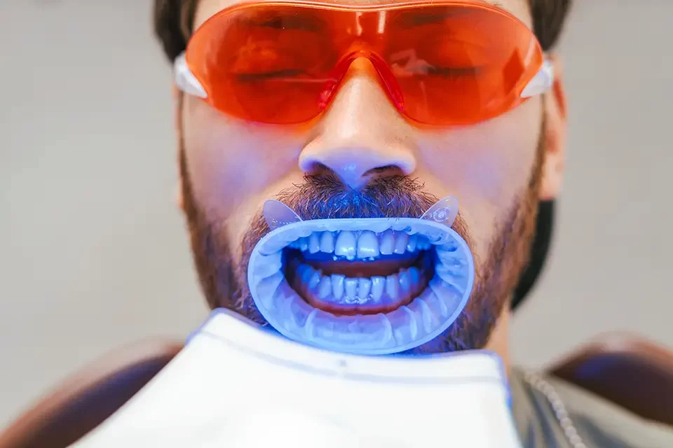 Realistic Timelines for Teeth Whitening Durability