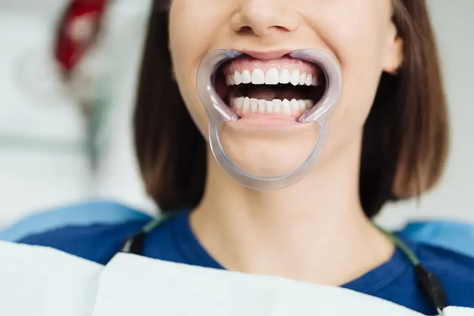 Difference Between Veneers and Composite Bonding: How the Procedures Actually Happen