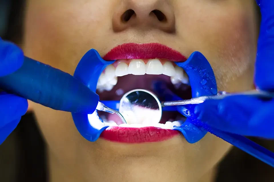 What Determines Teeth Whitening Durability? The Core Factors